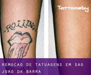 Remoção de tatuagens em São João da Barra