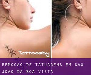 Remoção de tatuagens em São João da Boa Vista