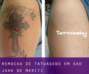 Remoção de tatuagens em São João de Meriti