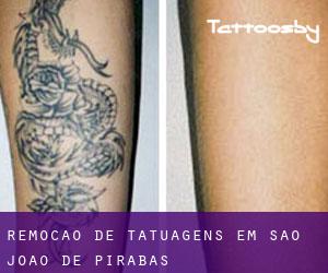 Remoção de tatuagens em São João de Pirabas