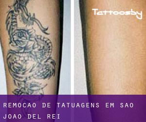Remoção de tatuagens em São João del Rei