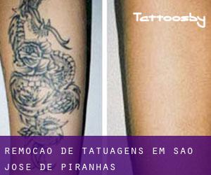 Remoção de tatuagens em São José de Piranhas