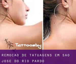 Remoção de tatuagens em São José do Rio Pardo
