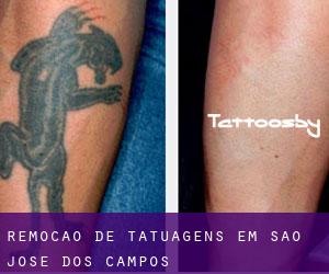 Remoção de tatuagens em São José dos Campos