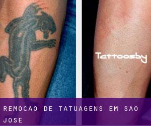Remoção de tatuagens em São José