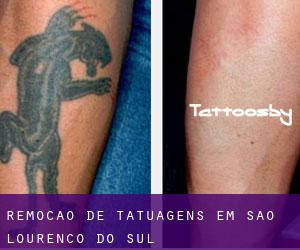 Remoção de tatuagens em São Lourenço do Sul
