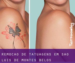 Remoção de tatuagens em São Luís de Montes Belos
