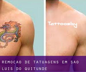 Remoção de tatuagens em São Luís do Quitunde