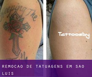 Remoção de tatuagens em São Luís