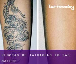 Remoção de tatuagens em São Mateus