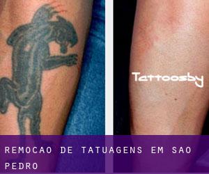 Remoção de tatuagens em São Pedro