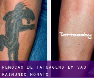 Remoção de tatuagens em São Raimundo Nonato