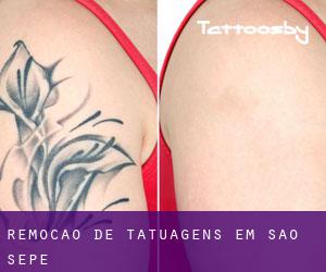 Remoção de tatuagens em São Sepé