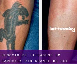 Remoção de tatuagens em Sapucaia (Rio Grande do Sul)