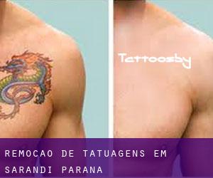 Remoção de tatuagens em Sarandi (Paraná)