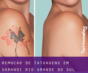 Remoção de tatuagens em Sarandi (Rio Grande do Sul)