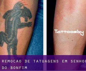 Remoção de tatuagens em Senhor do Bonfim