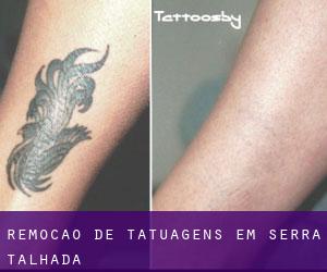 Remoção de tatuagens em Serra Talhada