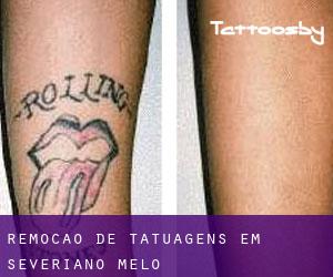 Remoção de tatuagens em Severiano Melo