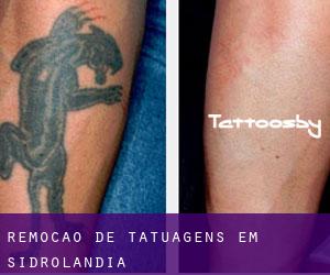 Remoção de tatuagens em Sidrolândia
