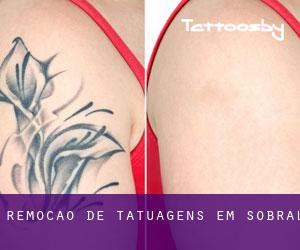 Remoção de tatuagens em Sobral