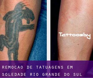 Remoção de tatuagens em Soledade (Rio Grande do Sul)