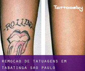 Remoção de tatuagens em Tabatinga (São Paulo)