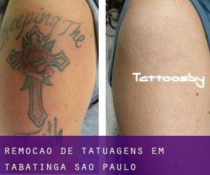 Remoção de tatuagens em Tabatinga (São Paulo)