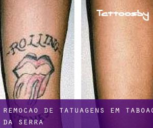 Remoção de tatuagens em Taboão da Serra