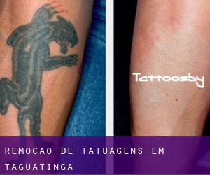 Remoção de tatuagens em Taguatinga