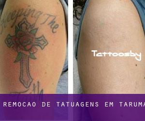 Remoção de tatuagens em Tarumã