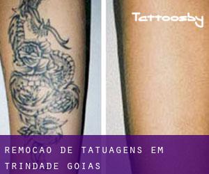 Remoção de tatuagens em Trindade (Goiás)