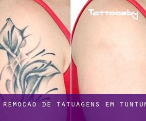 Remoção de tatuagens em Tuntum