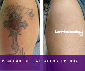 Remoção de tatuagens em Ubá