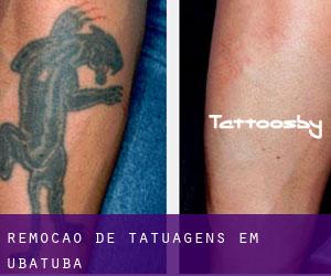 Remoção de tatuagens em Ubatuba