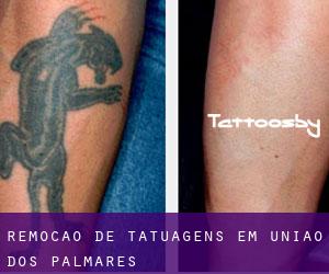 Remoção de tatuagens em União dos Palmares
