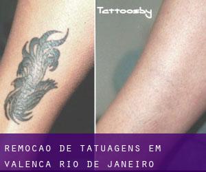 Remoção de tatuagens em Valença (Rio de Janeiro)
