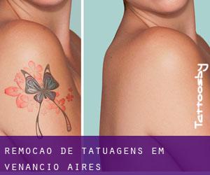 Remoção de tatuagens em Venâncio Aires