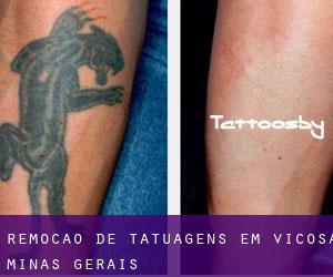Remoção de tatuagens em Viçosa (Minas Gerais)