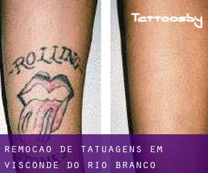 Remoção de tatuagens em Visconde do Rio Branco